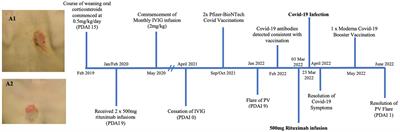 Considerations for the use of immunosuppression for the management of pemphigus during the COVID-19 pandemic with a focus on rituximab: Case reports from a single center experience in Australia